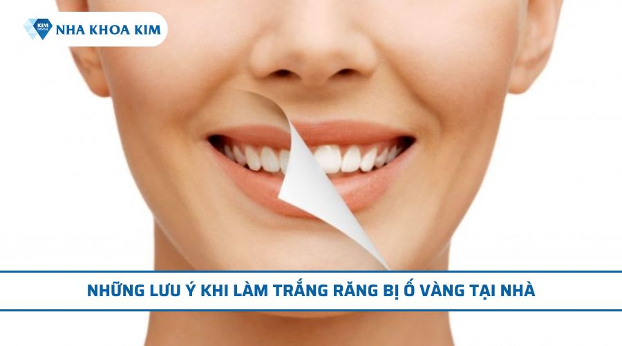 lưu ý khi làm trắng răng tại nhà