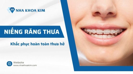 Niềng răng thưa – Khắc phục hoàn toàn thưa hở