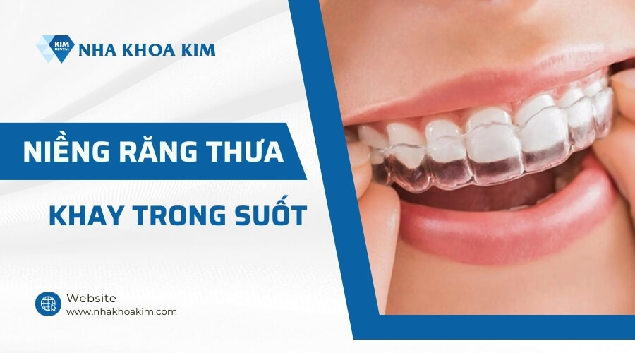 Niềng răng thưa trong suốt