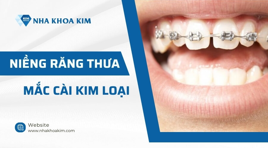 Niềng răng thưa mắc cài