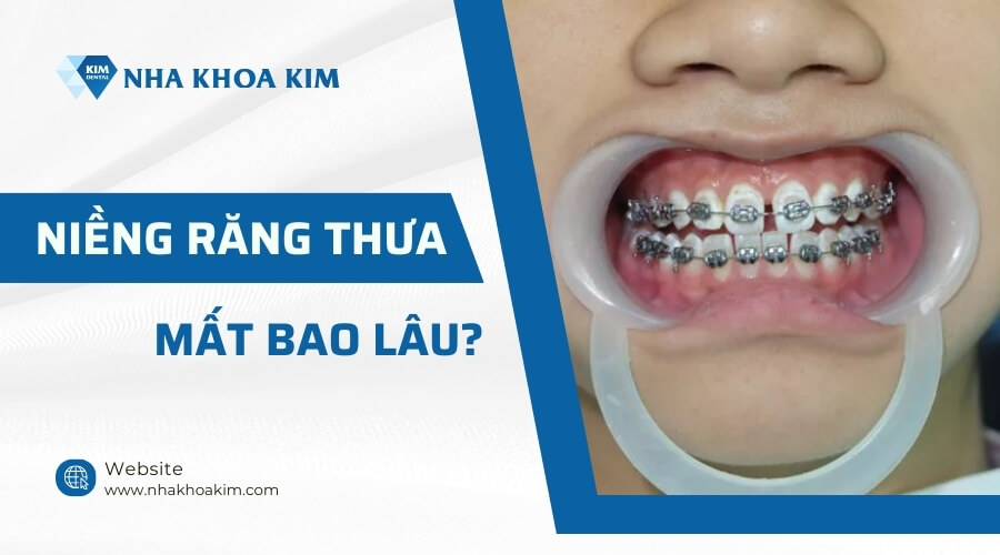 Niềng răng thưa mất bao lâu?