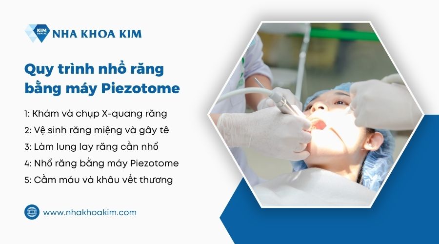 quy trình nhổ răng bằng sóng siêu âm