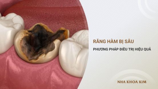 Răng hàm bị sâu: Các phương pháp điều trị hiệu quả