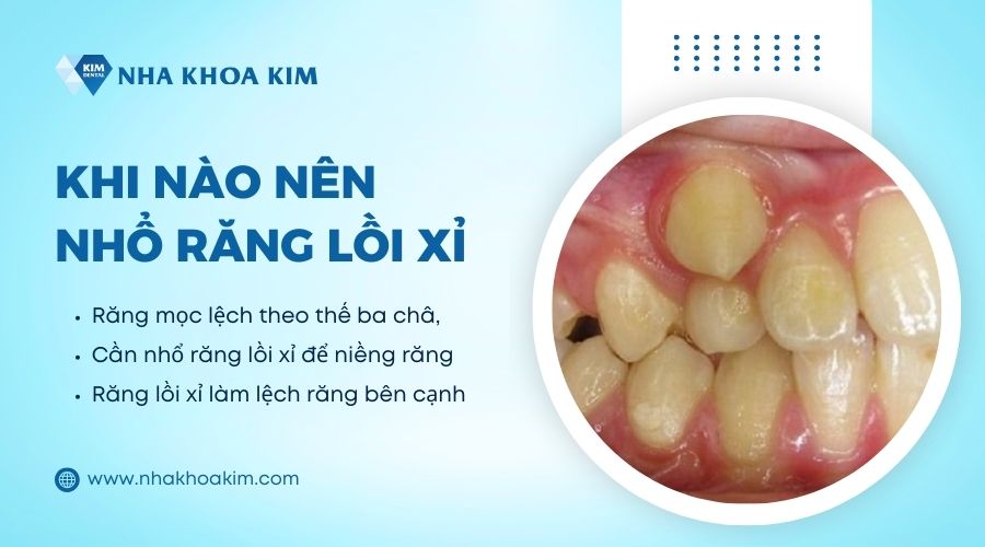 răng mọc lòi sĩ có nhổ được không