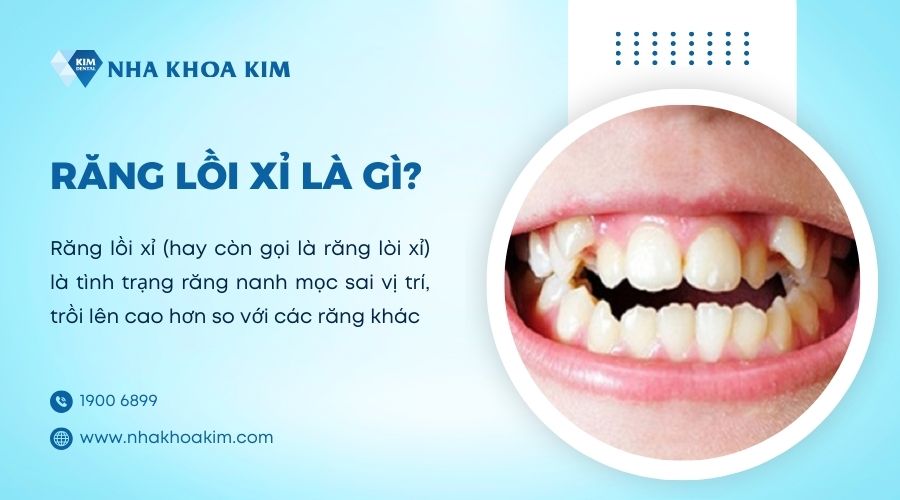 răng lồi xỉ là gì