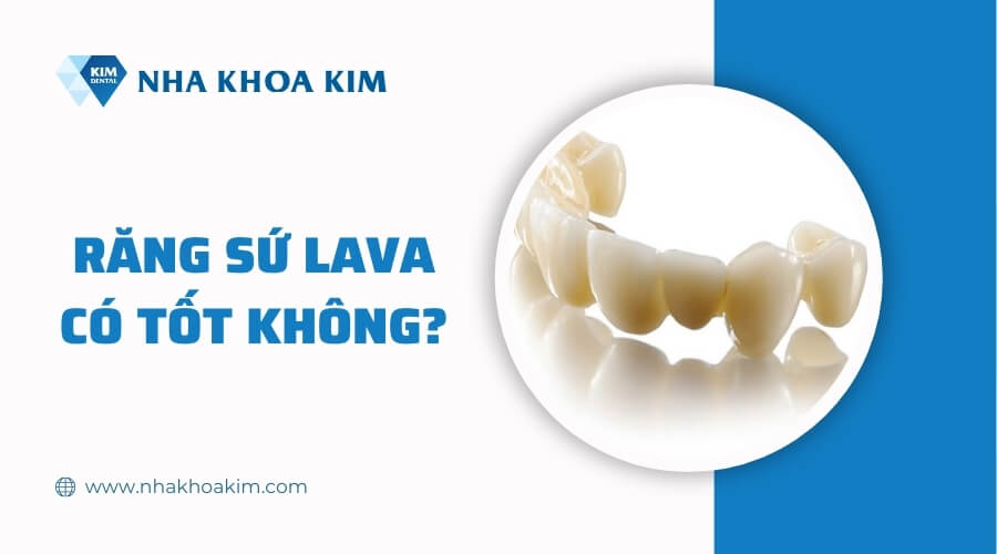 Răng sứ Lava có tốt không?