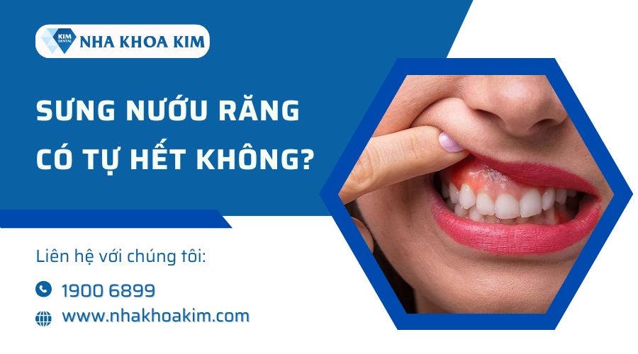 Sưng nướu răng có tự hết không?
