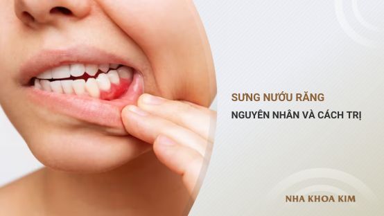 Sưng nướu răng: Nguyên nhân và cách điều trị