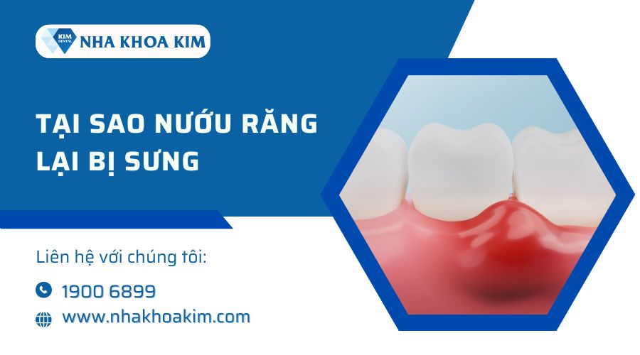 Tại sao nướu răng lại bị sưng?