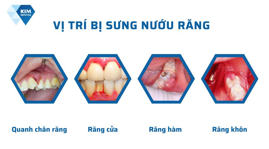 Vị trí sưng nướu răng
