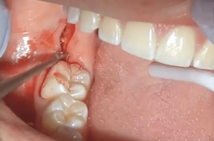 Khi nào nên tham khảo ý kiến từ nha sĩ về cách cầm máu khi nhổ răng số 8?
