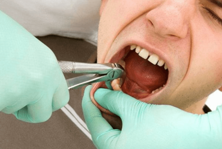 Cách cầm máu khi nhổ răng quá lâu