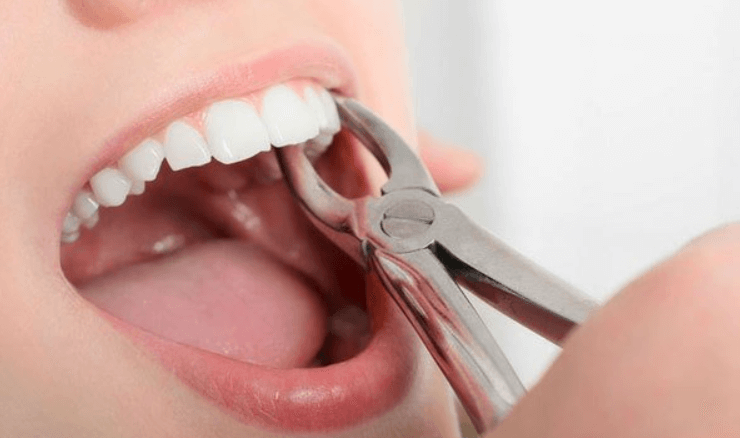 Nhổ răng khoảng bao lâu thì hết chảy máu?