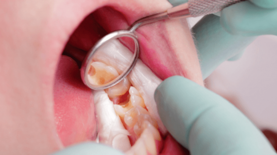 Chữa tủy răng cho bé & cách phòng ngừa viêm tủy răng hiệu quả
