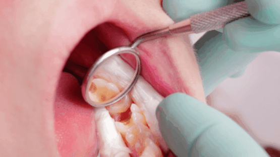 Chữa tủy răng cho bé & cách phòng ngừa viêm tủy răng hiệu quả