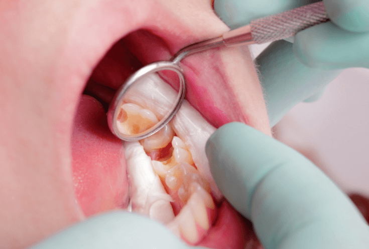 Trẻ nhỏ nên lấy tủy răng nếu có dấu hiệu viêm nhiễm tủy nặng