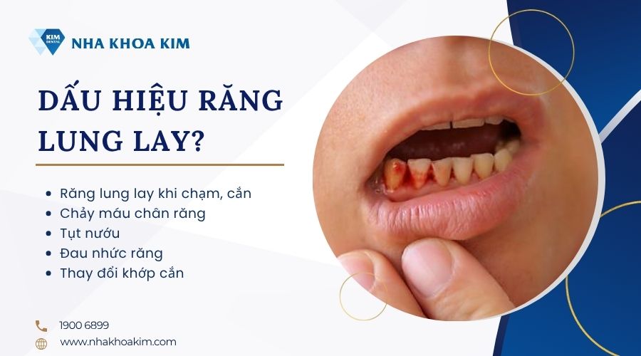 dấu hiệu nhận biết răng bị lung lay