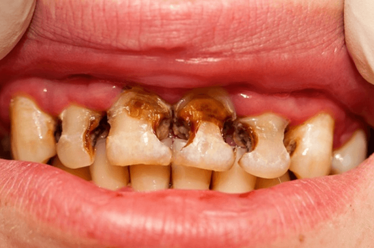 Đau răng do nguyên nhân bị sâu răng