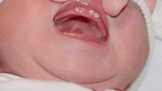 Hình ảnh nanh sữa ở trẻ sơ sinh và cách chữa trị nanh sữa