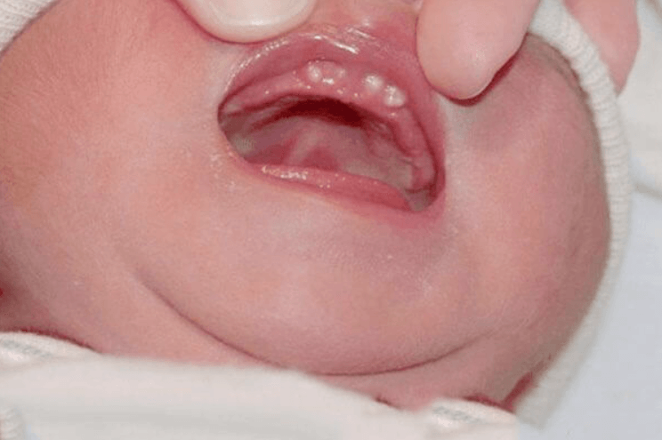 Hình ảnh nanh sữa ở trẻ sơ sinh 01