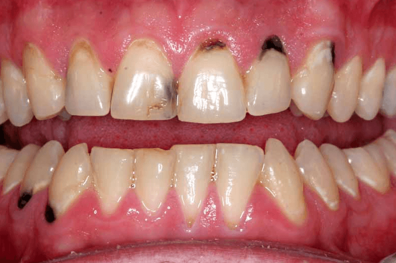 Sâu răng là nguyên nhân xảy ra hôi miệng