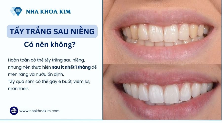 Có nên tẩy trắng răng sau niềng không