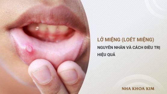Lở miệng (Viêm loét miệng): Nguyên nhân và cách điều trị
