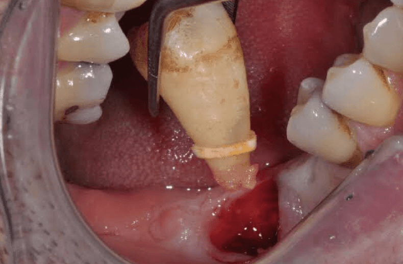 Cách chăm sóc đúng cách để lỗ răng nhanh đầy