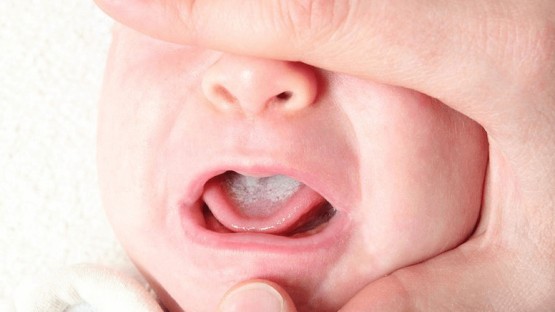 Mảng trắng trong miệng trẻ: Nguyên nhân và cách khắc phục