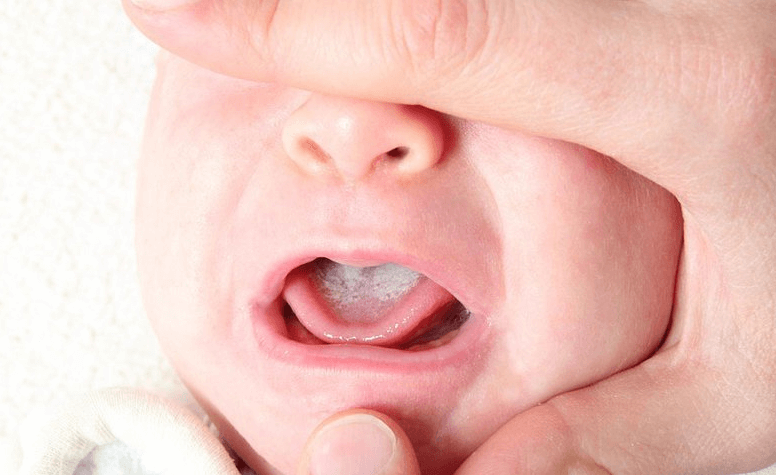 Mảng trắng trong miệng có nguy cơ mắc bệnh nấm miệng