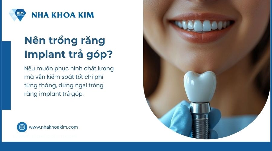 có nên trồng răng implant trả góp không