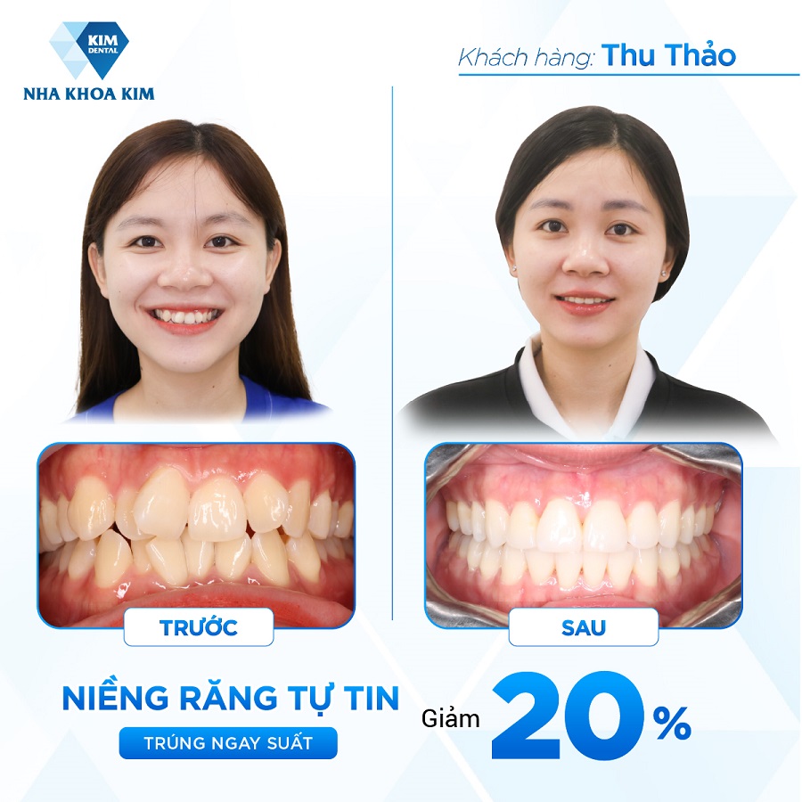 Hình ảnh trước - sau của khách hàng khi sử dụng dịch vụ nha khoa quận Thủ Đức của Nha Khoa Kim