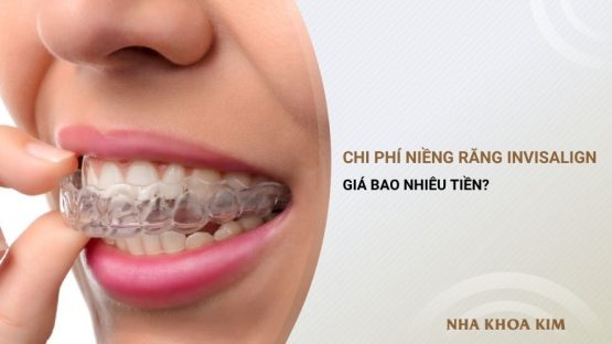Niềng răng Invisalign giá bao nhiêu? Tại sao lại đắt?