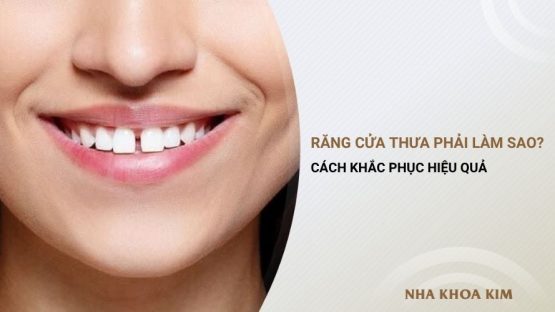 Răng cửa thưa nên làm gì? Cách khắc phục hiệu quả