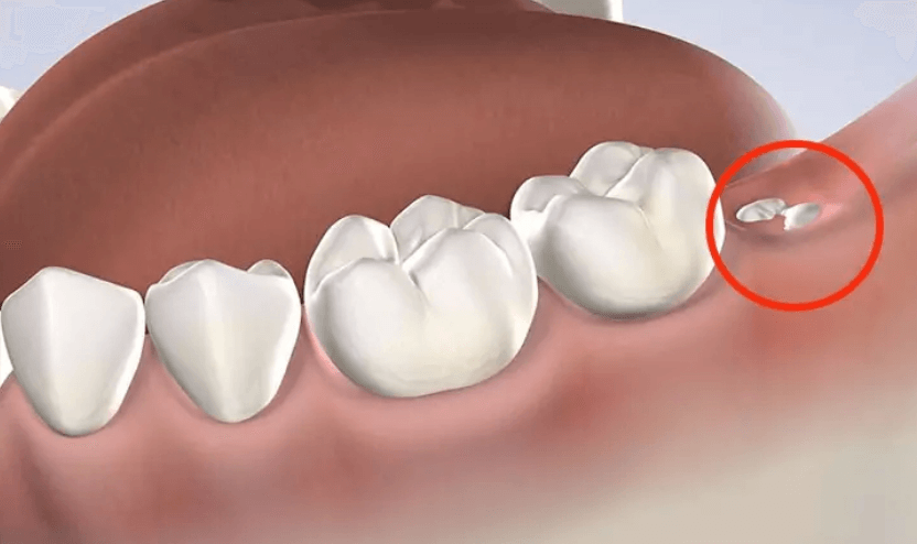 Có những cách nào để giúp bé giảm đau mất răng hàm?
