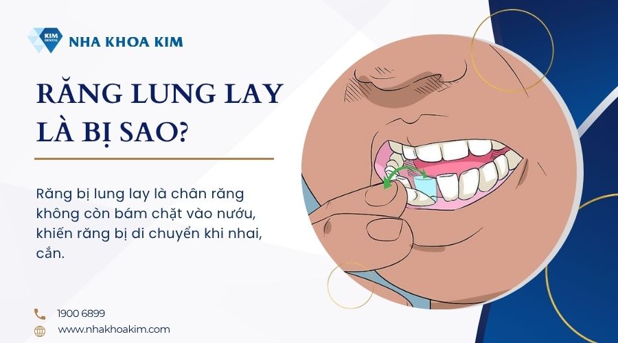 răng lung lay là bị sao