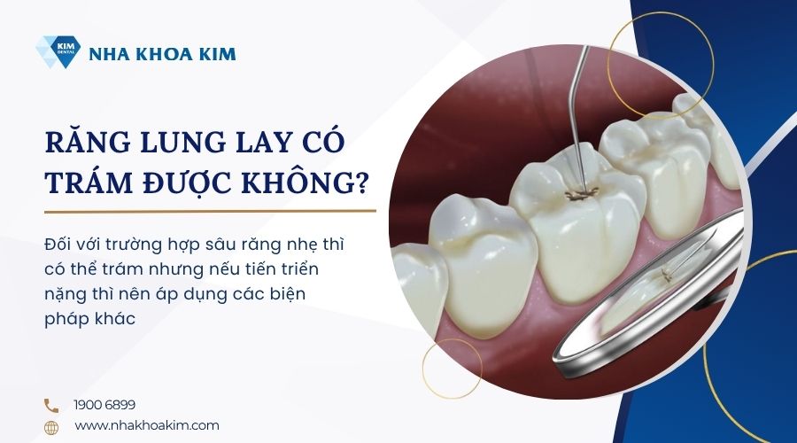 trám răng lung lay