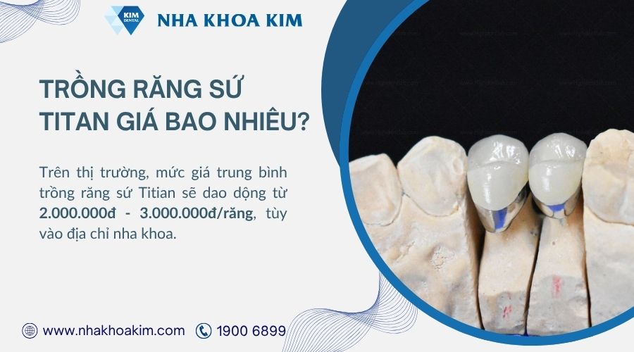 Trồng răng sứ titan giá bao nhiêu tiền