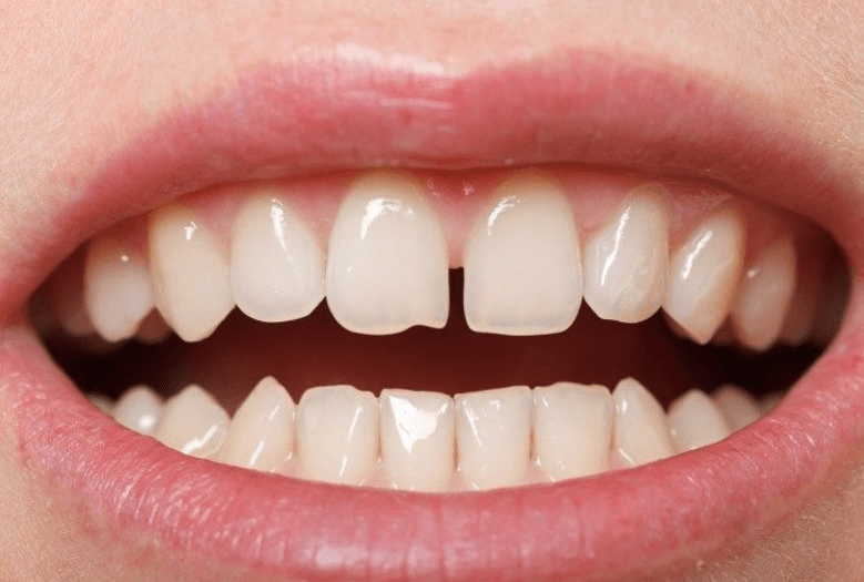 Răng thưa xuất phát từ nhiều nguyên nhân khác nhau
