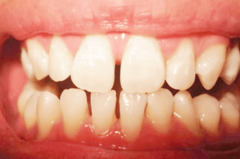 Cần khắc phục răng thưa sớm để lấy lại sự tự tin vốn có