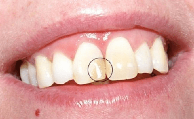 Trám răng là cách khắc phục răng thưa tạm thời