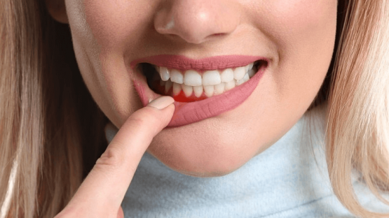 Sưng nướu răng và nổi hạch là bệnh gì & cách điều trị hiệu quả