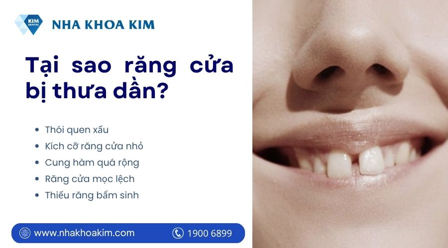 nguyên nhân răng cửa thưa