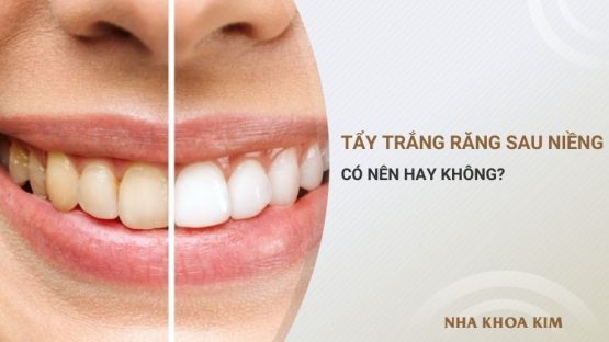 Có nên tẩy trắng răng sau khi niềng hay không?