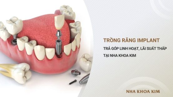Trồng răng trả góp tại Nha Khoa Kim – Giảm gánh nặng chi phí tối ưu