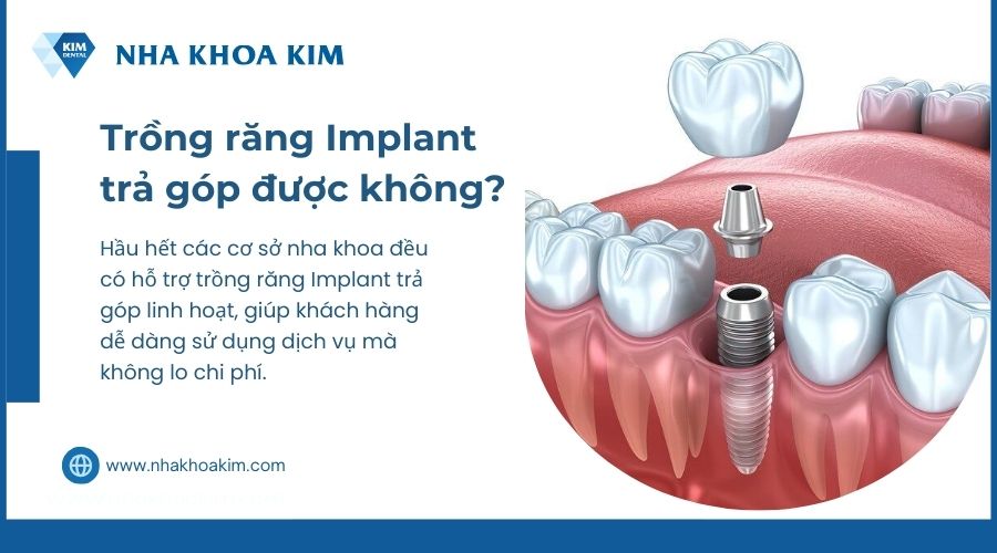 trồng răng implant trả góp được không