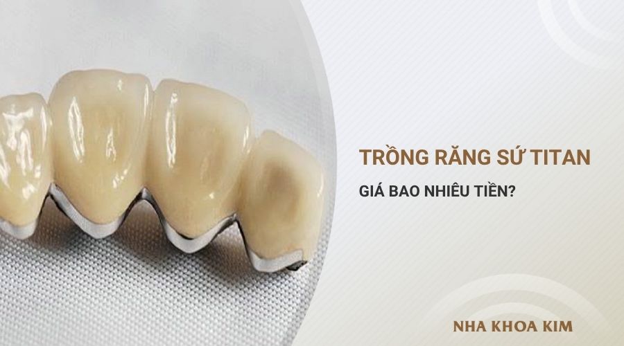 Trồng răng sứ Titan giá bao nhiêu tiền là mức giá chuẩn?