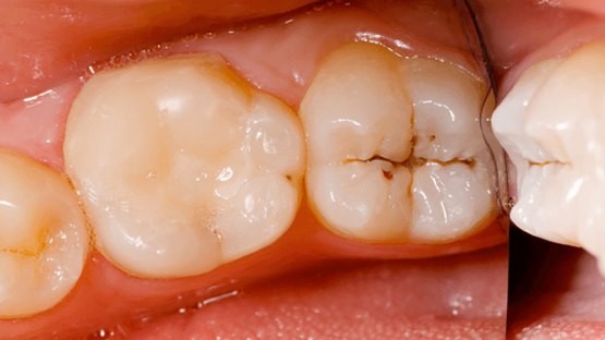 Vết đen trên răng hàm: Nguyên nhân và cách khắc phục hiệu quả