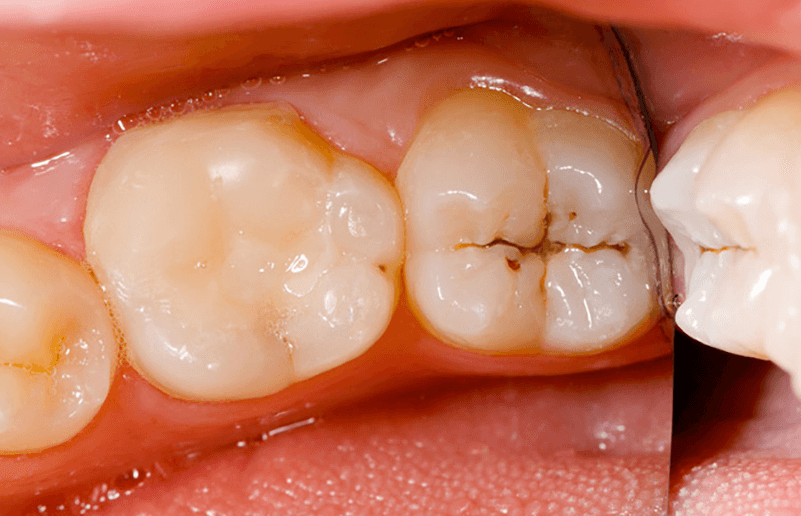 Vết đen trên răng hàm do bị sâu răng