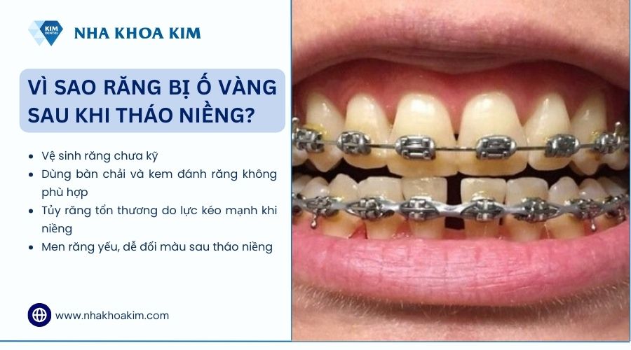 vì sao răng bị ố vàng sau khi tháo niềng